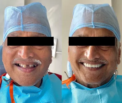 Full Arch Rehabilitation and implant case study