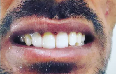 Anterior bridge smile restoration case study