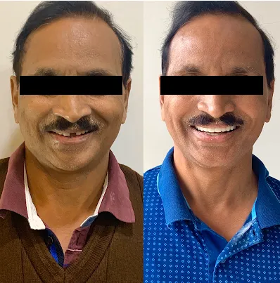 Anterior gap closure diastema case study