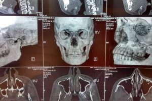 Facial fractures oral and maxillofacial surgery