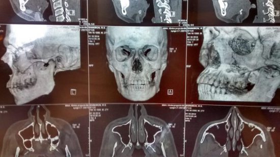 Facial fractures oral and maxillofacial surgery