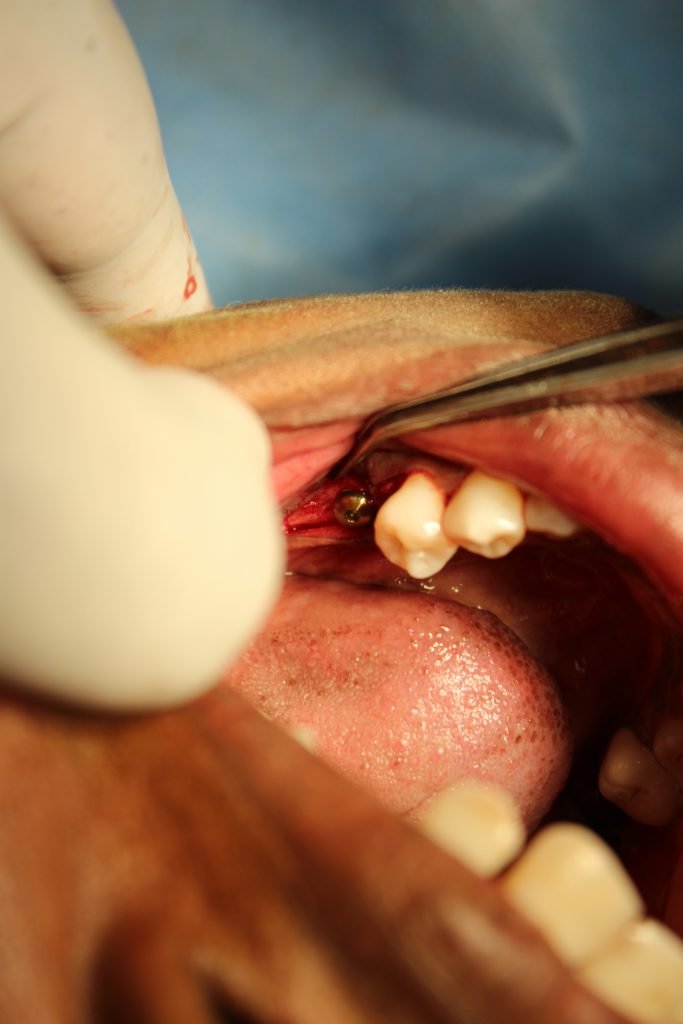 dental implant