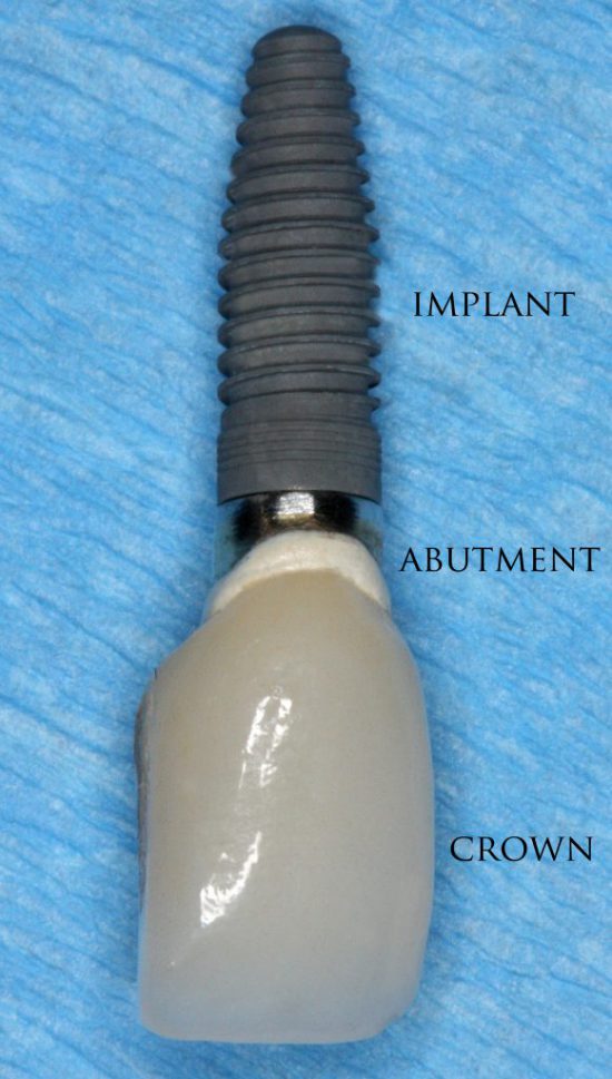 dental implant