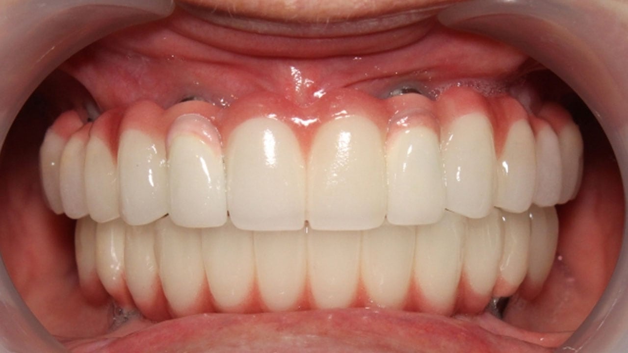 over denture