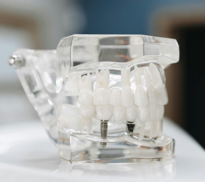 dental impant in clear model