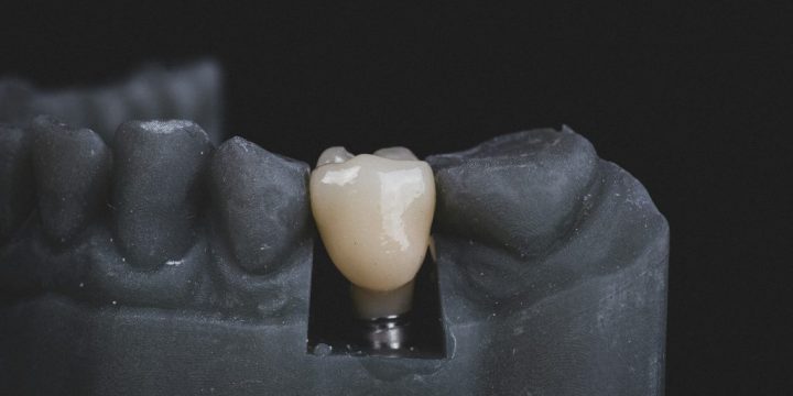 dental implant crown