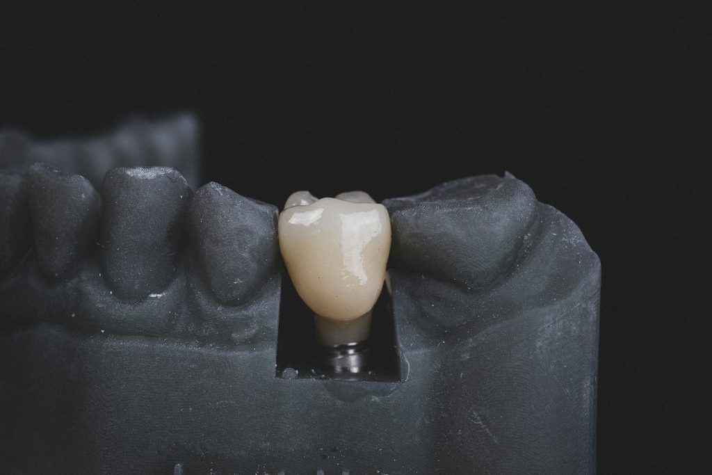 dental implant crown