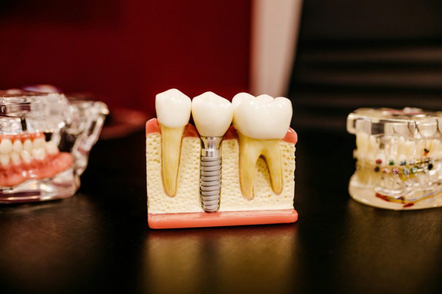 dental model with implant